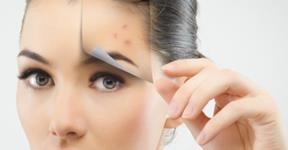 Safest Way to Remove Pimples without Leaving Scars