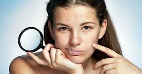 Diet To Stay Away Acne