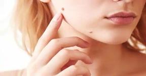 Simple and effective Home Remedies To Remove Skin Tags