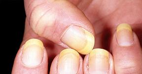 What Causes Yellowing Of Fingernails