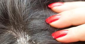 Homemade Remedies To Get Rid Of Dandruff