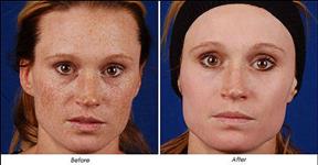 How To Get Rid Of Freckles