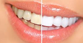 Natural treatment for teeth whitening