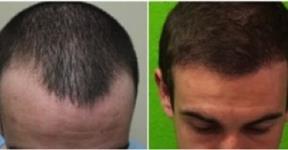 How to Increase Hair Growth Rate after a Hair Transplant