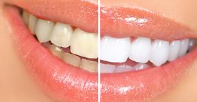 Best Home Remedies To Get White Shiny Teeth