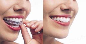 4 Important Tips for Parents of Teens Who Have Invisalign Braces