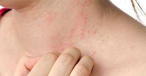 Sweat Rash Treatment and Prevention Tips