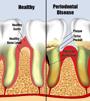 Periodontal diseases