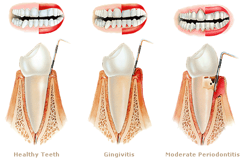 The relationship of periodontal disease to cardiovascular diseases — Review of literature